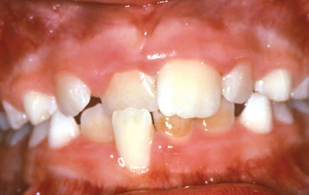 Close-up example of a crossbite before orthodontic treatment at Bernhardt & Smith Orthodontics, Bishop Drive Office and 50th Street Office in West Des Moines, IA