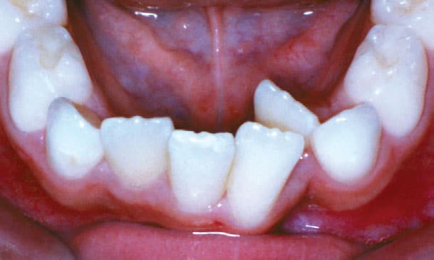 Close-up example of dental crowding before orthodontic treatment at Bernhardt & Smith Orthodontics, Bishop Drive Office and 50th Street Office in West Des Moines, IA