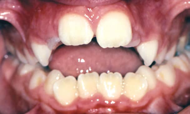 Close-up example of an open bite before orthodontic treatment at Bernhardt & Smith Orthodontics, Bishop Drive Office and 50th Street Office in West Des Moines, IA