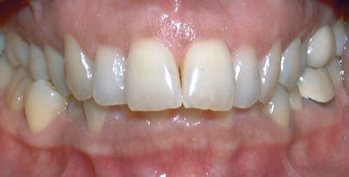 Close-up example of an overbite before orthodontic treatment at Bernhardt & Smith Orthodontics, Bishop Drive Office and 50th Street Office in West Des Moines, IA