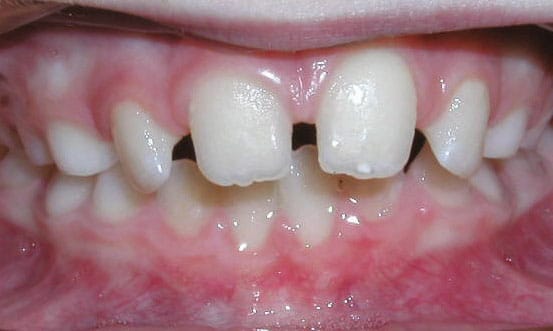 Close-up example of spacing between teeth before orthodontic treatment at Bernhardt & Smith Orthodontics, Bishop Drive Office and 50th Street Office in West Des Moines, IA