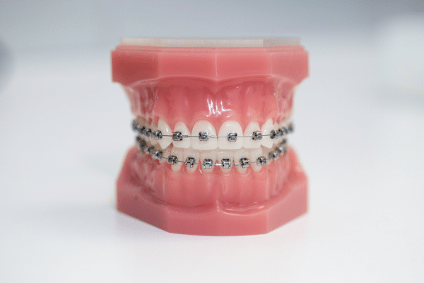 Dental model with metal braces for metal and clear braces treatment at Bernhardt & Smith Orthodontics, Bishop Drive Office and 50th Street Office in West Des Moines, IA